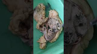 seminoma testis  lung abscess  lipoma  breast adenocarcinoma  renal cell carcinoma pathology [upl. by Neelcaj]