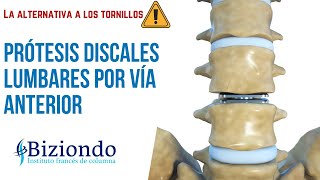 ▷▷Cirugía de columna lumbar sin tornillos Prótesis discales lumbares por vía abdominal  Biziondo [upl. by Jarrid768]