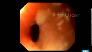 Endoscopic Appearance of Meckels Diverticulum [upl. by Ygief]