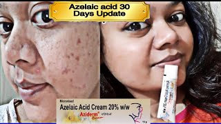 Azelaic acid 30 Days Update  Aziderm 20 ww Cream Review  Pimples को कैसे रोके [upl. by Ecirpak]