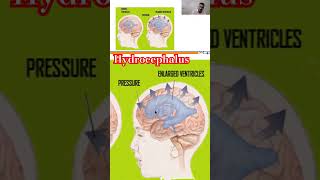 Hydrocephalus nursingcompetition hydrocephalus [upl. by Dlorah]