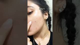 😌Remove pimple in overnight permanentlyOvernight Acne Treatment ytshorts viralvedios acneremoval [upl. by Bruce]