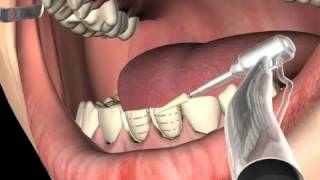 What are Dental Veneers [upl. by Solegnave]