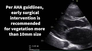 Cardiac vegetations in focus [upl. by Slorac]