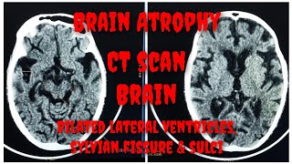 CT Scan of Brain  Brain Atrophy  CT Brain Findings  Age related cortical Atrophy Prasad Layek [upl. by Asined]