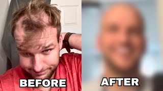 BALDING MAN Has INSANE GLOW UP [upl. by Saimerej]