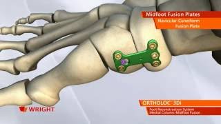 Ortholoc Midfoot Fusion Animation [upl. by Missi363]