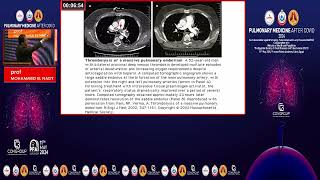 HIGH RISK PULMONARY EMBOLISM [upl. by Purcell343]