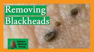 Several Blackheads  Auburn Medical Group [upl. by Tamar]