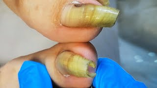 Trim extra long toenail like cicada chrysalis  Satisfying video [upl. by Radnaskela794]