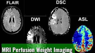 MRI Perfusion Weight Imaging [upl. by Ericka]