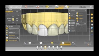 How we produce upper front dental veneers in less than 24 hours using CadCam Technology [upl. by Ariet]