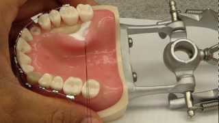 Palatal Flap Elevation Assistance  Connective tissue graftCrown Lengthening [upl. by Ariet]