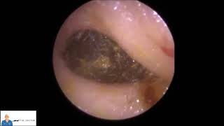 تنظيف شمع الاذن عند الطبيب docotor earwax removal [upl. by Scharff12]