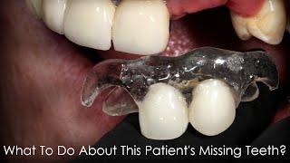 What to do About This Patients Missing Teeth [upl. by Esilrac92]