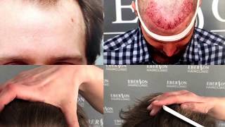 Haartransplantatie met 1600 grafts  EBERSON HAIR CLINIC [upl. by Ermey]