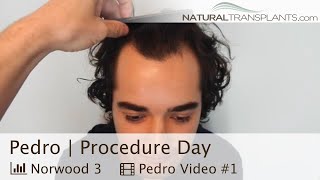 Defeating a Receding Hairline Hair Transplant at 23 for Norwood 3 Hair Loss  Dr Huebner Pedro [upl. by Azitram538]