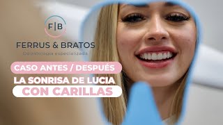 💋 CARILLAS DENTALES de PORCELANA ✨ Sonrisa perfecta [upl. by Delisle]