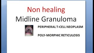 ENT Non healing Midline Granuloma compare Wegener Granulomatosis Diagnosis Treatment EBV [upl. by Canada81]