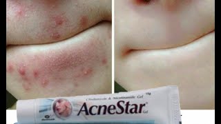 AcneStar Gel Remove Acne  Pimples  BlackheadsComplete Review हिन्दी मैं [upl. by Kathlin]