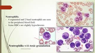 Practical Hematology 11 Morphology of Benign WBCs disorders [upl. by Dasteel]