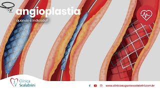 Quando é Indicada a Angioplastia [upl. by Shyamal]