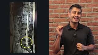 l4 l5 lumbar disc protrusion recovery after 4 years [upl. by Arhas]