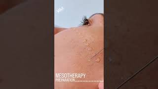 Mesotherapy Facial Treatment Benefits Procedure amp FAQ  EDEN AESTHETICS Dubai [upl. by Velvet18]