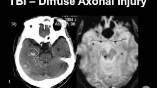 Diagnosing Brain Hemorrhages [upl. by Eidurt]