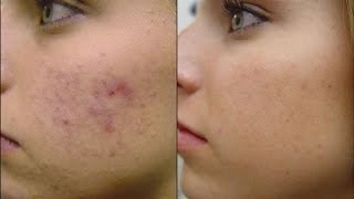 Mascarilla para el Acne y Anti Edad Natural para Todo Tipo de Piel [upl. by Andriana740]