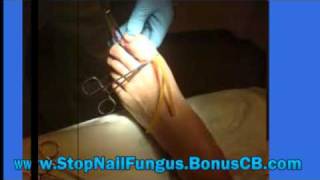 nail fungus home remedies  how to cure fungus nails [upl. by Slater649]