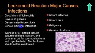 LEUKEMOID REACTION 4TH YR [upl. by Hanway899]