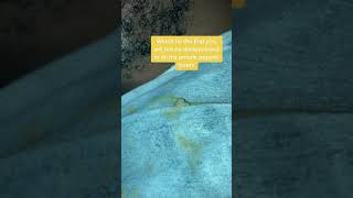 infected ingrown hair removal [upl. by Donnamarie919]