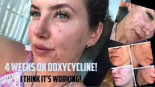 ACNE amp Doxycycline  First 4 weeks  Update [upl. by Andras101]