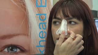 Nose and Chin Blackhead Removal from Skin [upl. by Adne]