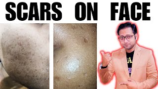 Scars on face  Atrophoderma vermiculatum 🔥 Treatment  Hindi [upl. by Hartnett409]