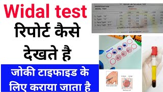 Widal test रिपोर्ट कैसे देखते है  Typhoid Test कैसे किया जाता है [upl. by Agnes]