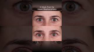 Upper Blepharoplasty Before amp After  Dr Paul Nassif [upl. by Akaenahs169]