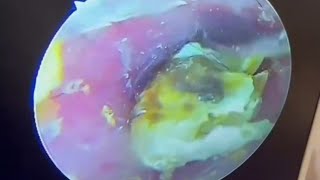 Cleaning up a plethora of moldy fungi in the ears earwax Cleaning earwaxremoval satisfying [upl. by Saffian]