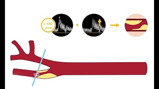 Identifying carotid artery disease with ultrasound [upl. by Suidaht46]