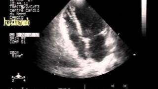 dissecting hematoma of the interventricular septum with biventricular apical small thrombi [upl. by Ok230]