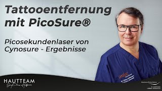 Tattooentfernung mit PicoSure® Picosekundenlaser von Cynosure  Ergebnisse [upl. by Ayocal725]