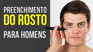 Preenchimento de Mandibula e Malar em Homens  Rosto Masculino  Dr Erlacher [upl. by Celisse]