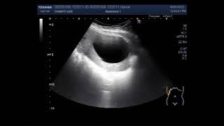 Hydatid Hepatic Cyst [upl. by Cynde]