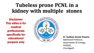 Prone PCNL in a kidney with multiple calyceal stones [upl. by Asiar]