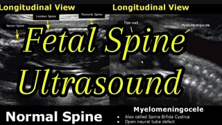 Fetal Spine Ultrasound Normal Vs Abnormal Images Appearances  Spinal Abnormalities  Obstetrics USG [upl. by Liebman]