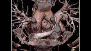 Cardiac Compression of trachea by right aortic arch with attempted double aortic arch 5 of 5 [upl. by Paynter]