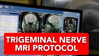 Trigeminal Nerve MRI scan protocol positioning and planning [upl. by Adniralc]