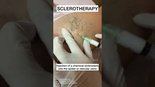 Sclerotherapy for Spider and Varicose Veins Shorts [upl. by Darcie]