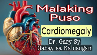 Cardiomegaly Enlarged Heart  Dr Gary Sy [upl. by Laucsap]